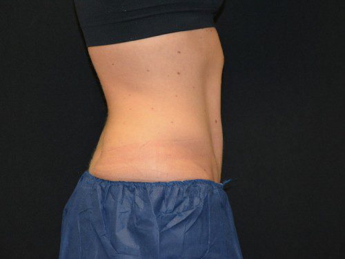 Coolsculpting After Patient 5