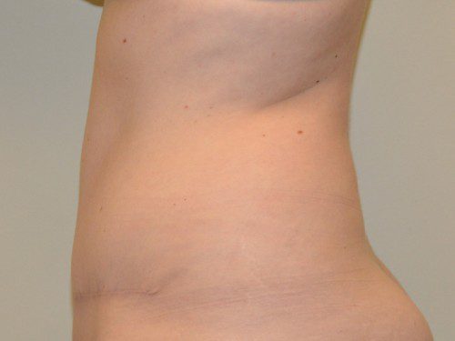 Tummy Tuck After Patient 5