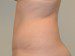 Tummy Tuck After Patient Thumbnail 5