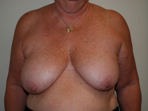 Breast Reconstruction Tissue Expanders Before Patient 1