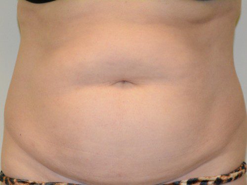 Tummy Tuck Before Patient 1