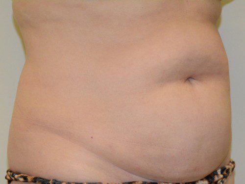 Tummy Tuck Before Patient 2