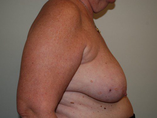 Breast Reconstruction Tissue Expanders Before Patient 4