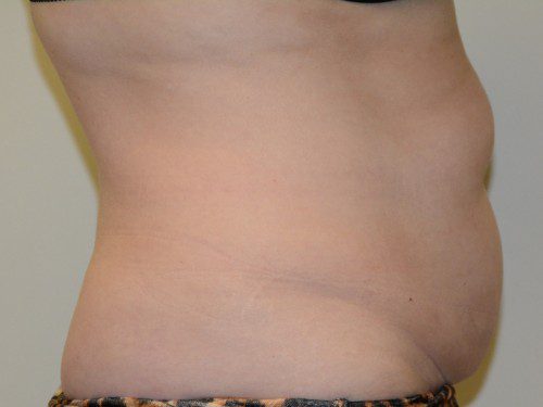 Tummy Tuck Before Patient 4