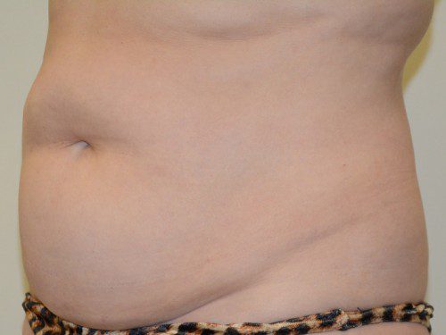 Tummy Tuck Before Patient 3