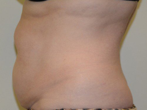 Tummy Tuck Before Patient 5