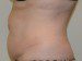 Tummy Tuck Before Patient Thumbnail 5
