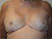Breast Reconstruction Tissue Expanders After Patient Thumbnail 1