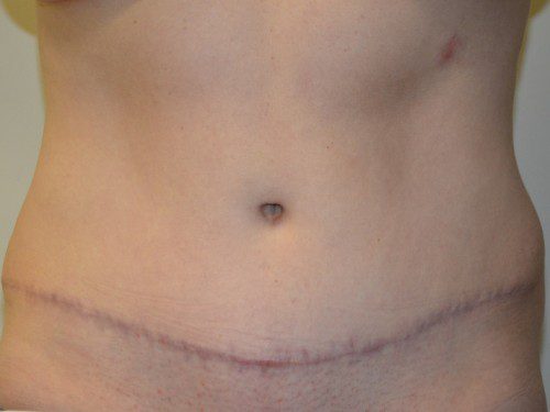 Tummy Tuck After Patient 1