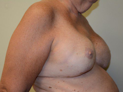 Breast Reconstruction Tissue Expanders After Patient 2