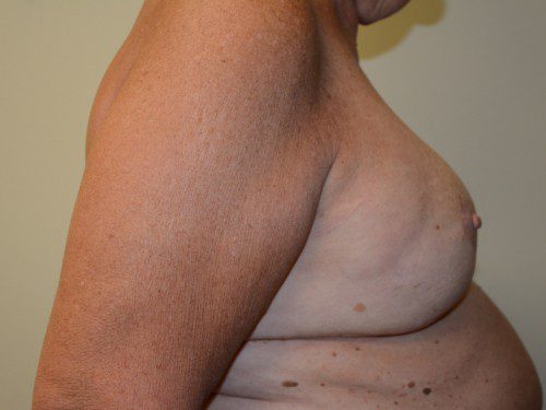 Breast Reconstruction Tissue Expanders After Patient 4