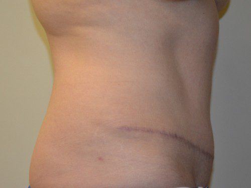 Tummy Tuck After Patient 4