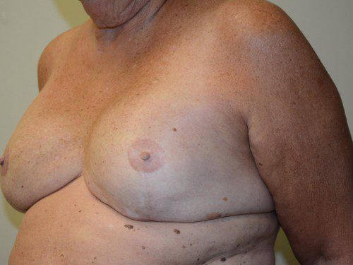 Breast Reconstruction Tissue Expanders After Patient 3