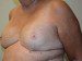 Breast Reconstruction Tissue Expanders After Patient Thumbnail 3