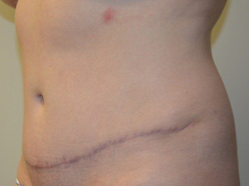 Tummy Tuck After Patient 3