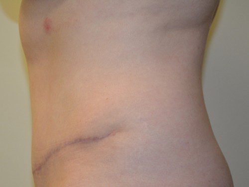 Tummy Tuck After Patient 5