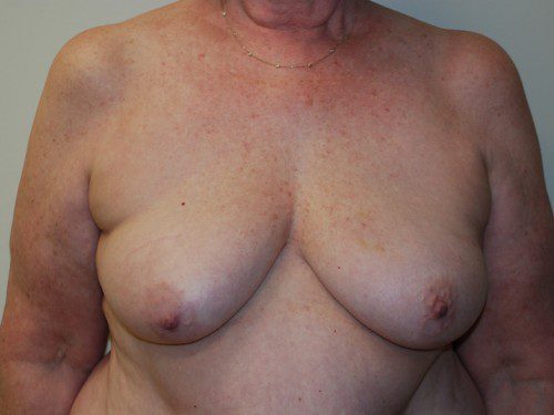 Breast Reconstruction Tissue Expanders Before Patient 1