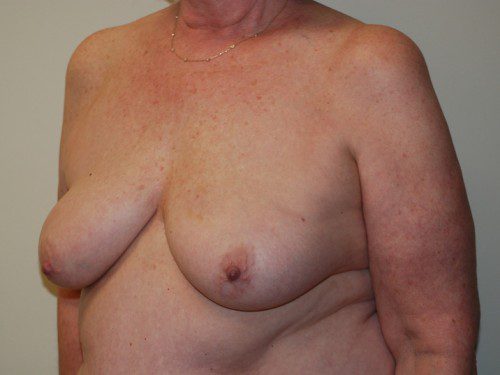 Breast Reconstruction Tissue Expanders Before Patient 2