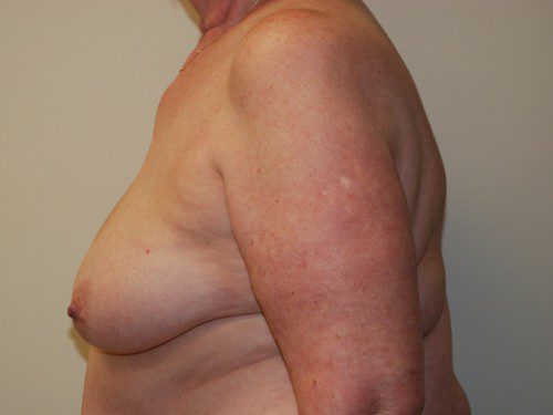 Breast Reconstruction Tissue Expanders Before Patient 5