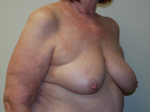 Breast Reconstruction Tissue Expanders Before Patient 3