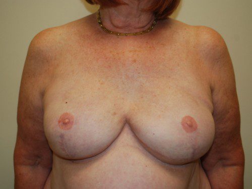 Breast Reconstruction Tissue Expanders After Patient 1