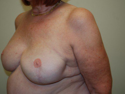 Breast Reconstruction Tissue Expanders After Patient 2