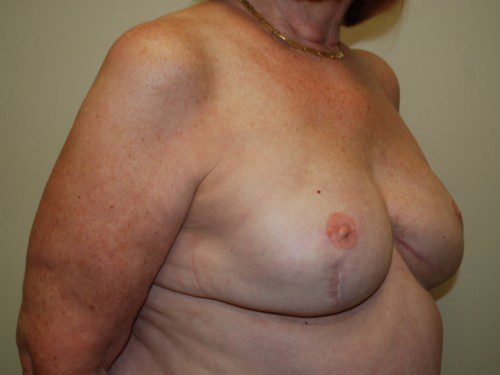 Breast Reconstruction Tissue Expanders After Patient 3