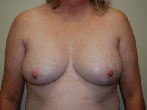 Breast Reconstruction Tissue Expanders Before Patient 1