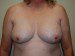 Breast Reconstruction Tissue Expanders Before Patient Thumbnail 1