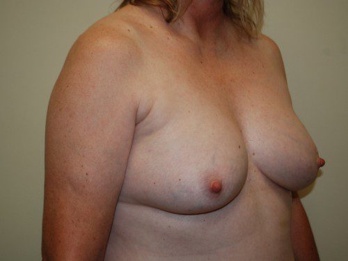 Breast Reconstruction Tissue Expanders Before Patient 2