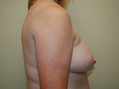 Breast Reconstruction Tissue Expanders After Patient 4