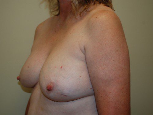 Breast Reconstruction Tissue Expanders Before Patient 3