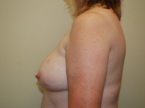 Breast Reconstruction Tissue Expanders Before Patient 5