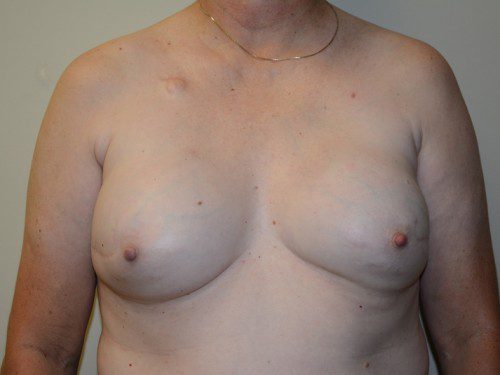 Breast Reconstruction Tissue Expanders After Patient 1