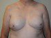 Breast Reconstruction Tissue Expanders After Patient Thumbnail 1