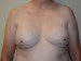 Breast Reconstruction Tissue Expanders After Patient Thumbnail 1