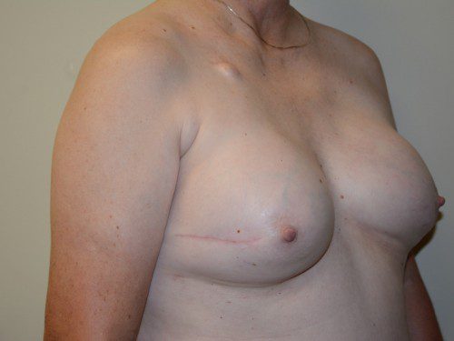 Breast Reconstruction Tissue Expanders After Patient 2