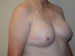 Breast Reconstruction Tissue Expanders After Patient Thumbnail 2