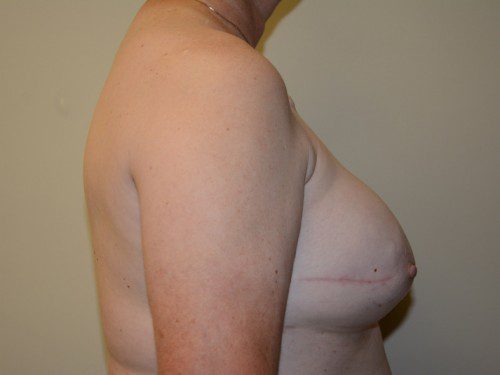 Breast Reconstruction Tissue Expanders After Patient 4