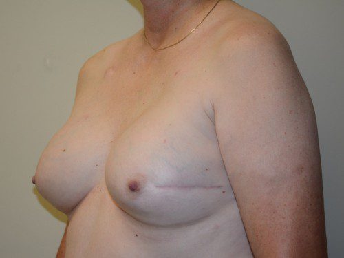 Breast Reconstruction Tissue Expanders After Patient 3