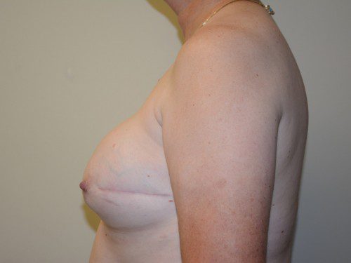 Breast Reconstruction Tissue Expanders After Patient 5