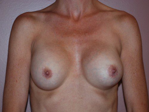 Breast Revision Before Patient 1