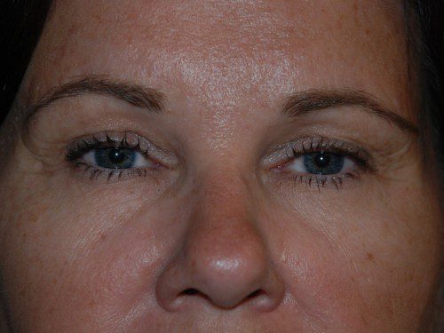 Brow Lift Before Patient 1