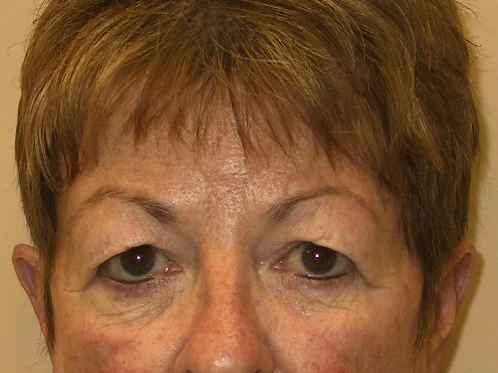 Eyelid Surgery Before Patient 1