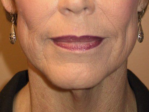 Facelift Before Patient 1