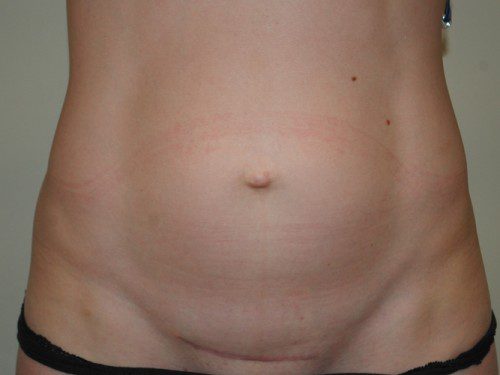 Mini Tummy Tuck Before Patient 1