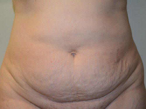 Tummy Tuck Before Patient 1