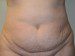 Tummy Tuck Before Patient Thumbnail 1