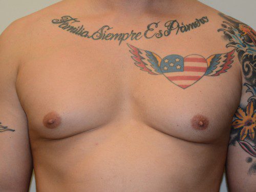 Male Breast Reduction Before Patient 1