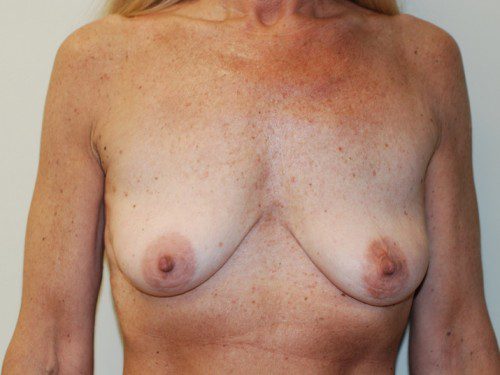 Breast Augmentation w/Lift Before Patient 1